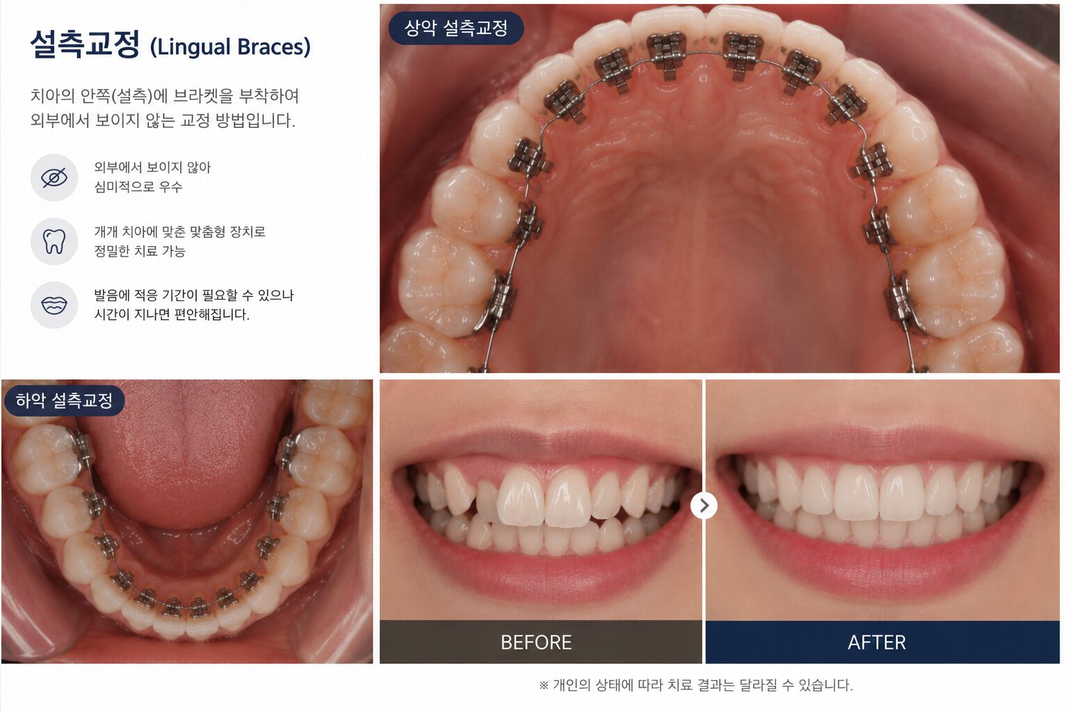 송도 설측교정 치아 안쪽 부착 장치 예시 연세꿈꾸는치과교정과