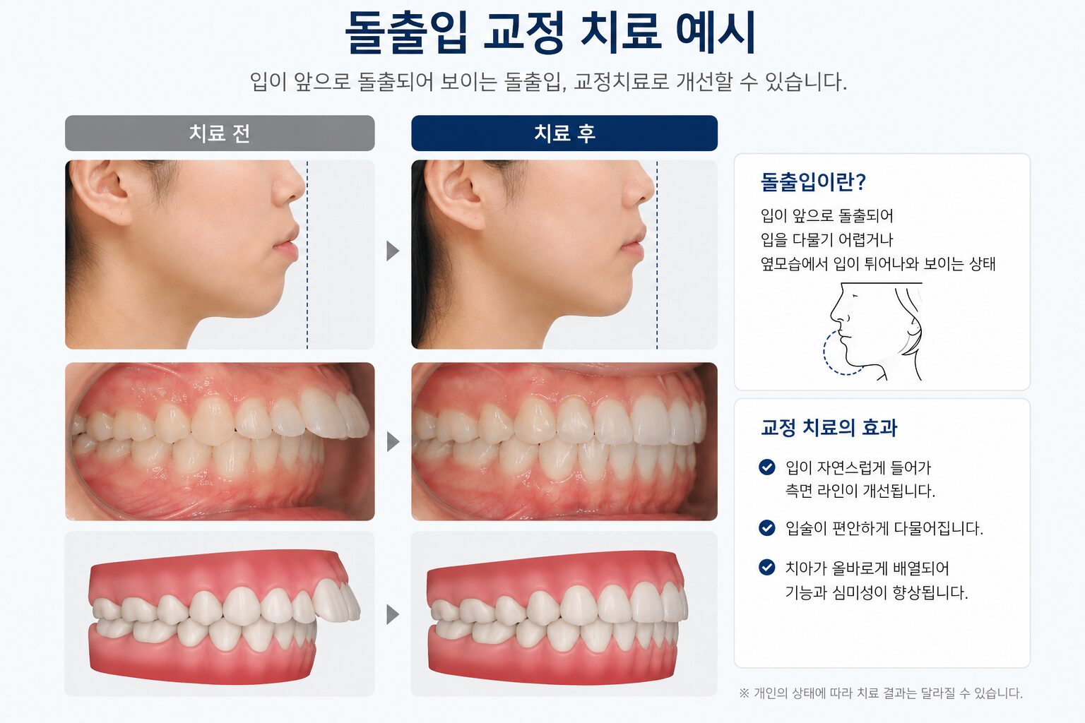 송도 돌출입 교정 옆모습 입매 라인 개선 예시 연세꿈꾸는치과교정과