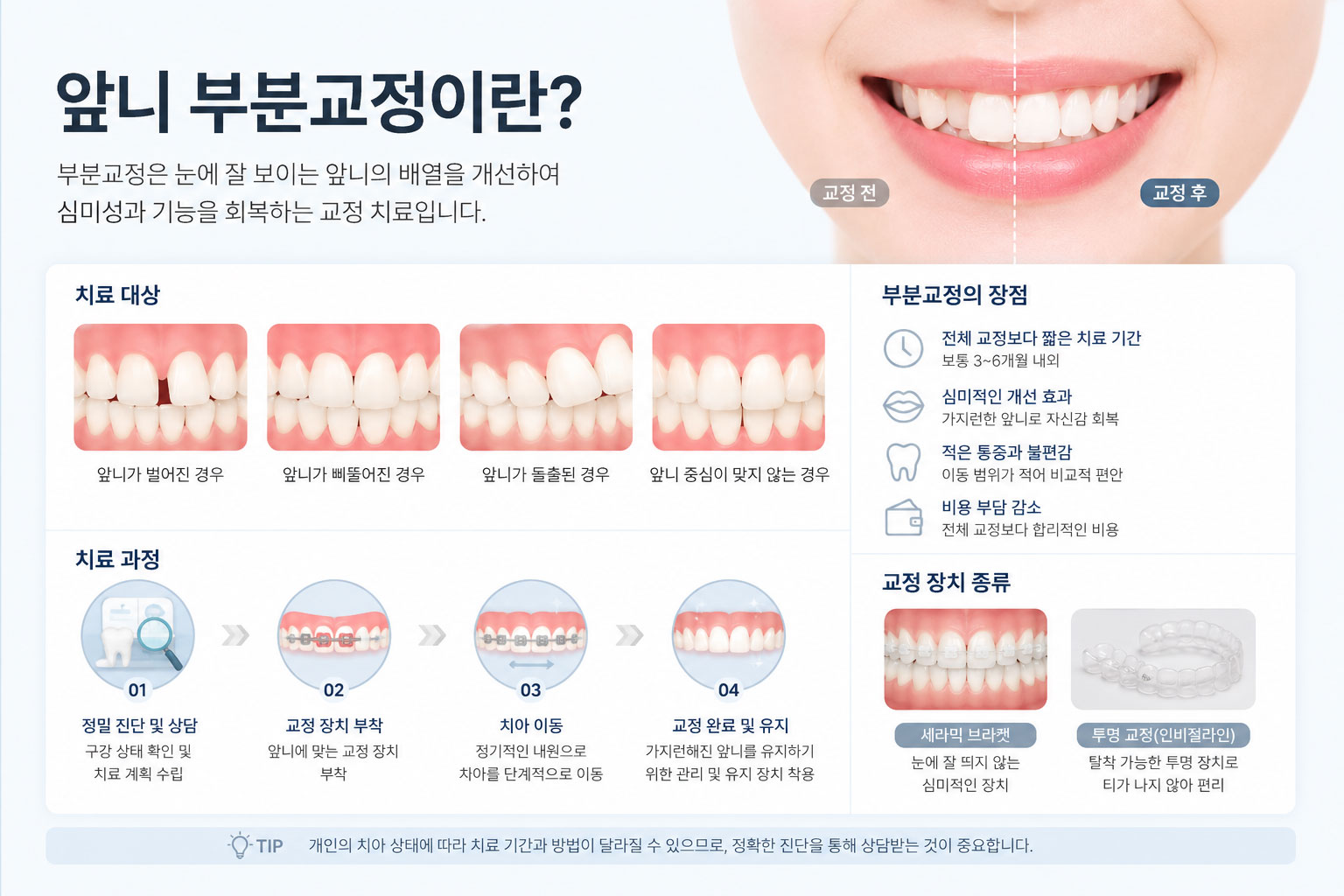 송도 부분교정 앞니 부분 교정 설명 연세꿈꾸는치과교정과